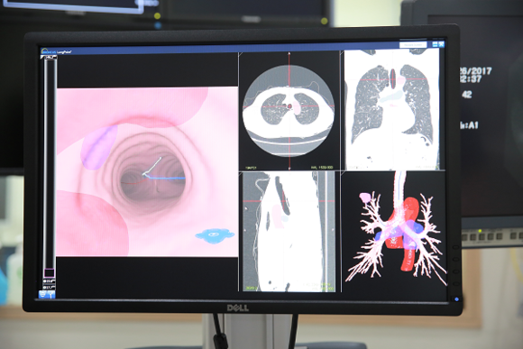 가상 기관지내시경 네비게이션 장비 모습. (사진=부산대병원)